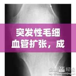 突发性毛细血管扩张,成因、症状及治疗方案一网打尽!