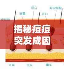 揭秘痘痘突发成因,预防与应对痘痘爆发全攻略!